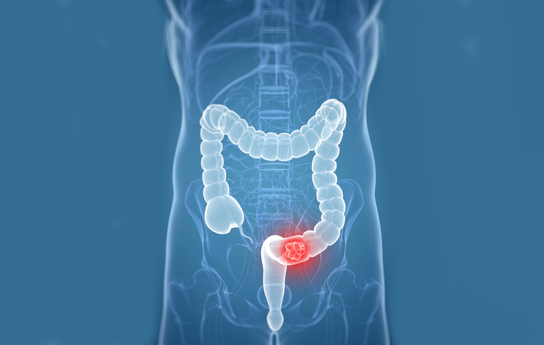 Colorectal Cancer
